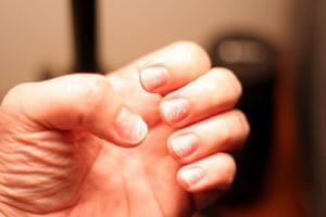 Чтобы укрепить и восстановить ногти, прибегают к пяти процедурам