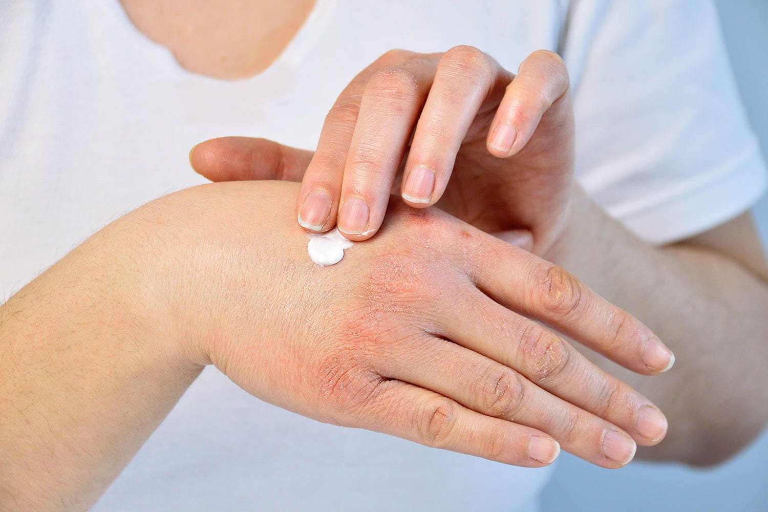 Сухая кожа рук и дерматит – что делать и как предотвратить?