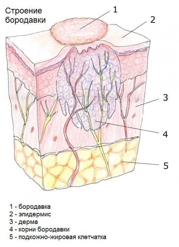 Бородавка картинка в разрезе