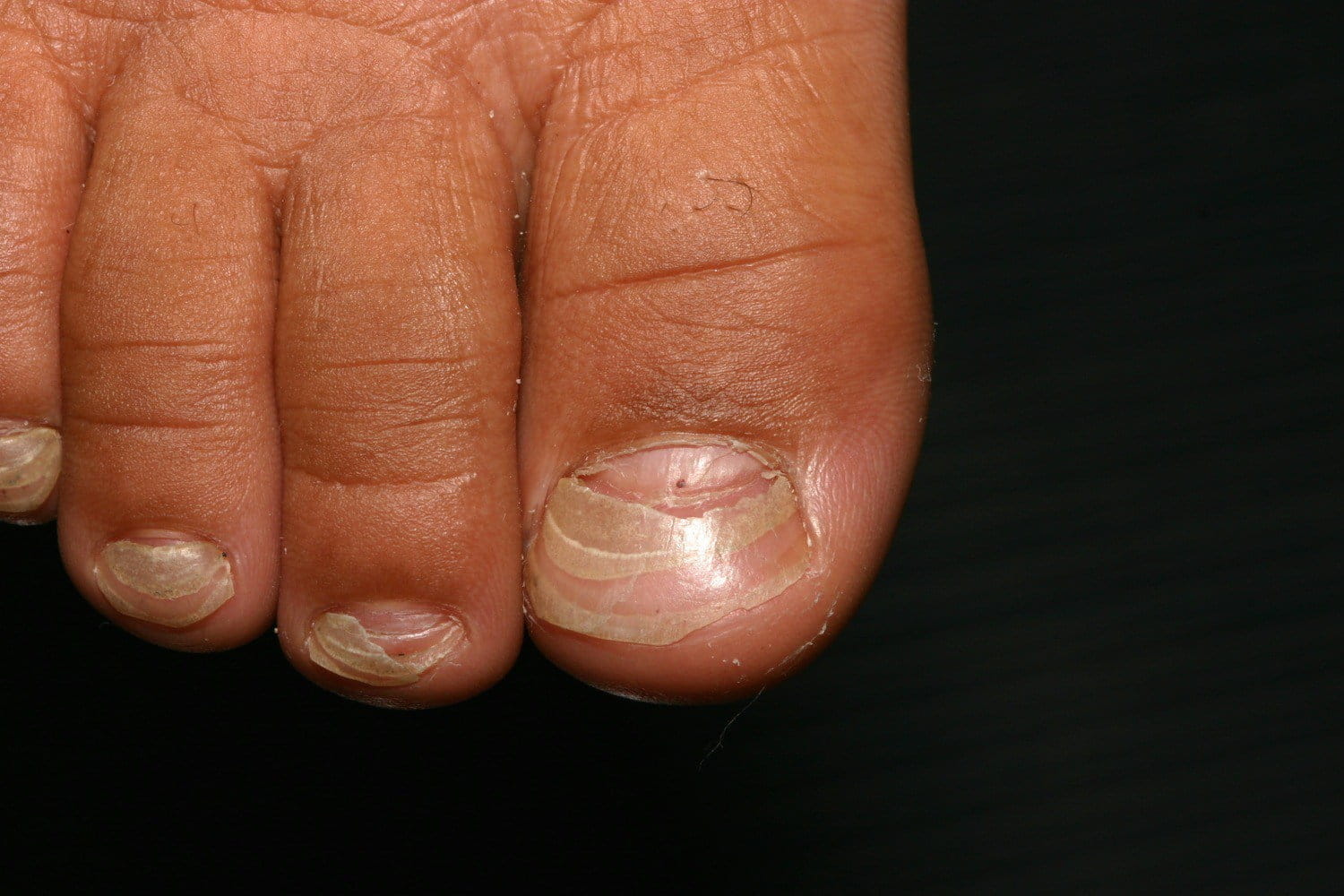 Гиперкератоз ногтей и кожи – как распознать и лечить