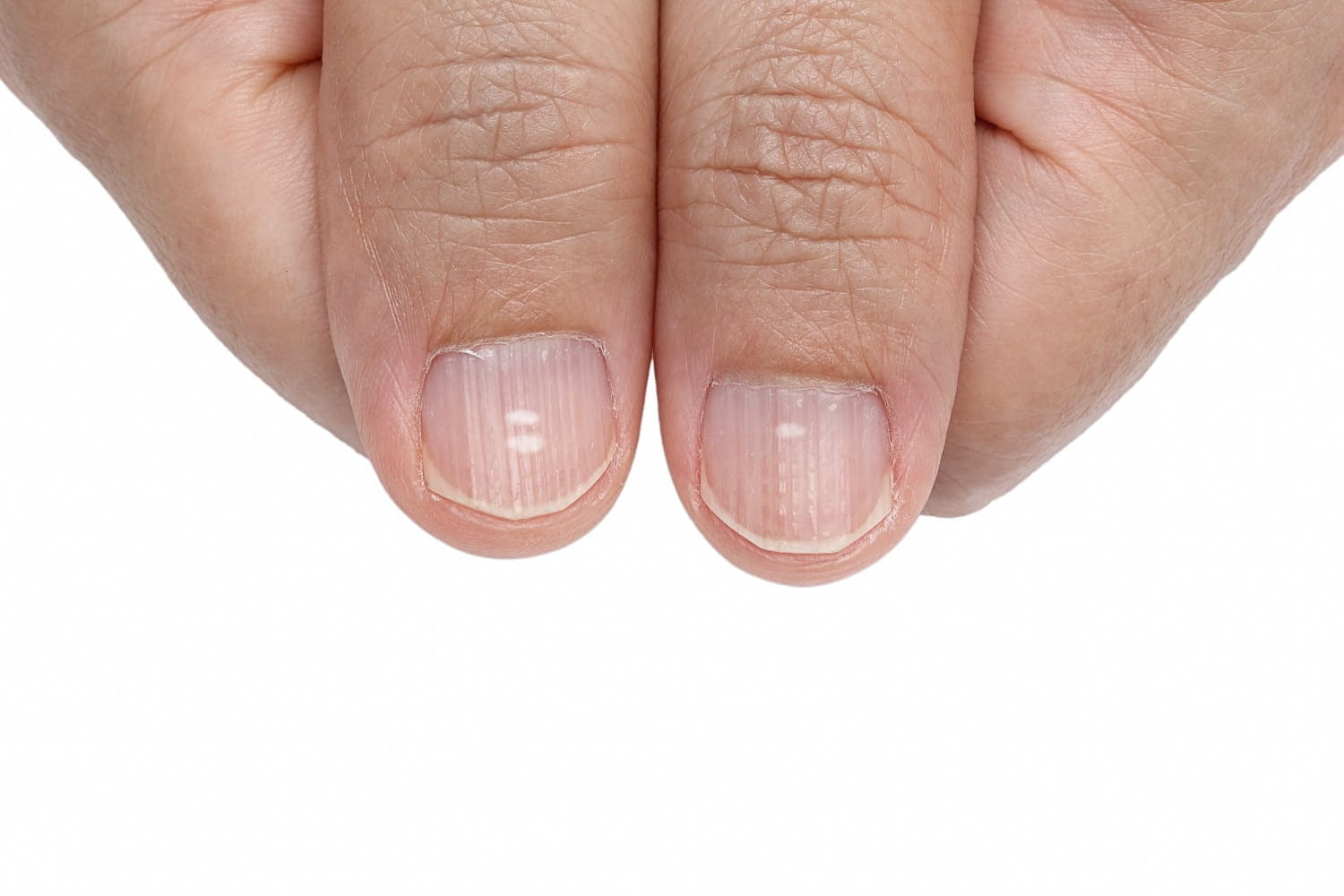 Борозды Бо-Рейля, или что означают вмятины на ногтях?