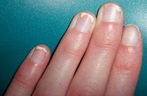 Виды и симптомы ногтевого псориаза