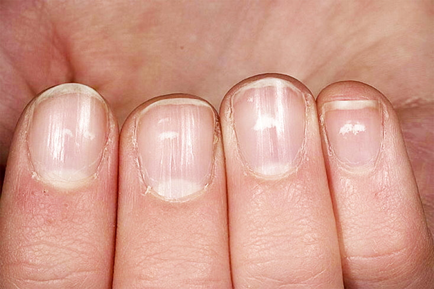Лейконихия – что означают белые пятна на ногтях и как их лечить