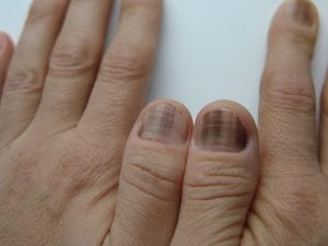 Коричневые пятна на ногтях