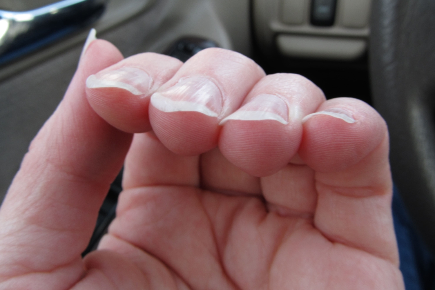 Загибаются ногти на пальцах – что делать?
