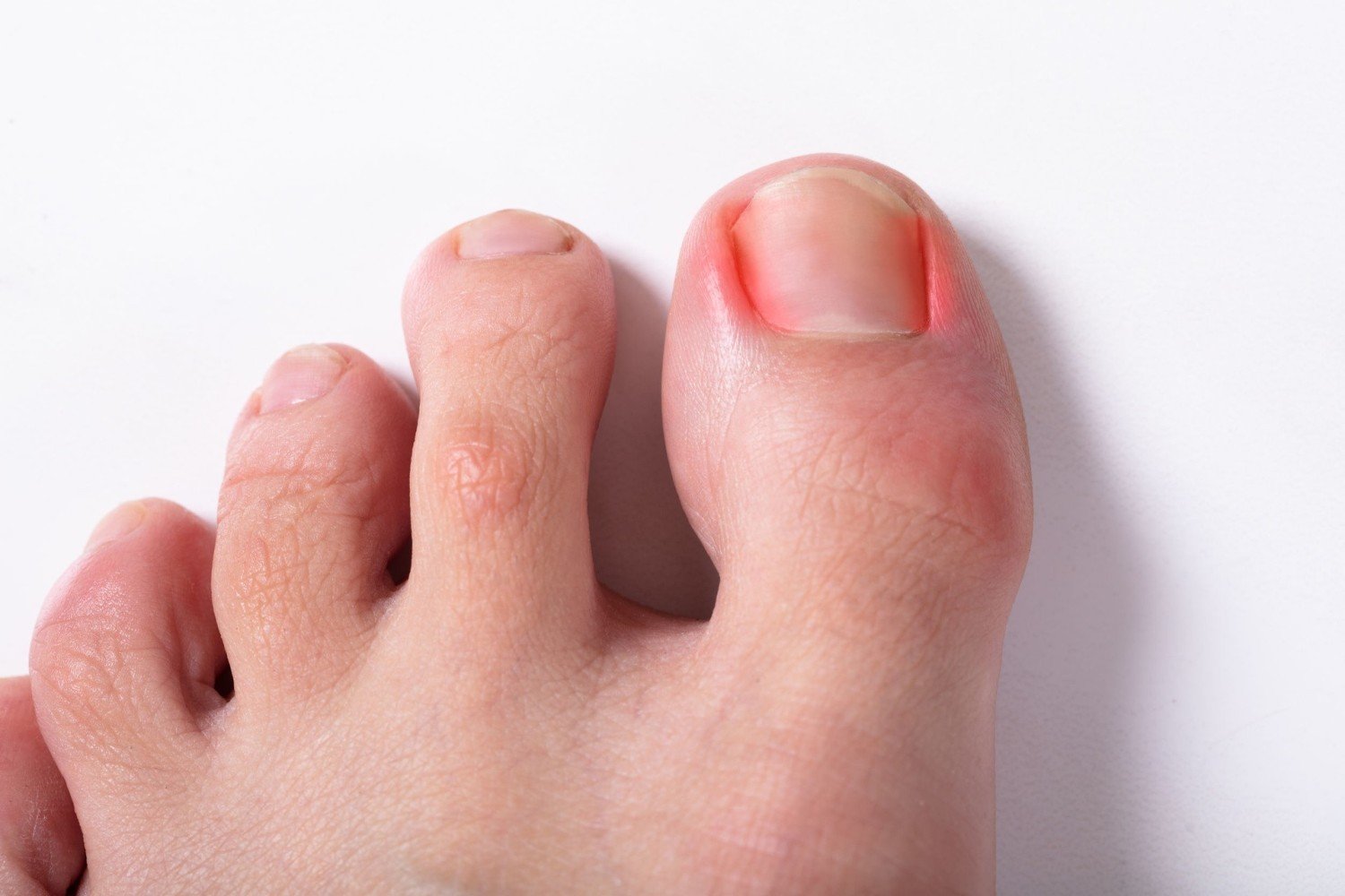 Врастание ногтя (онихокриптоз) – почему возникает патология и как лечить ее на разных стадиях