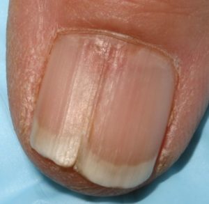 Причины появления трещин на ногтях и коже