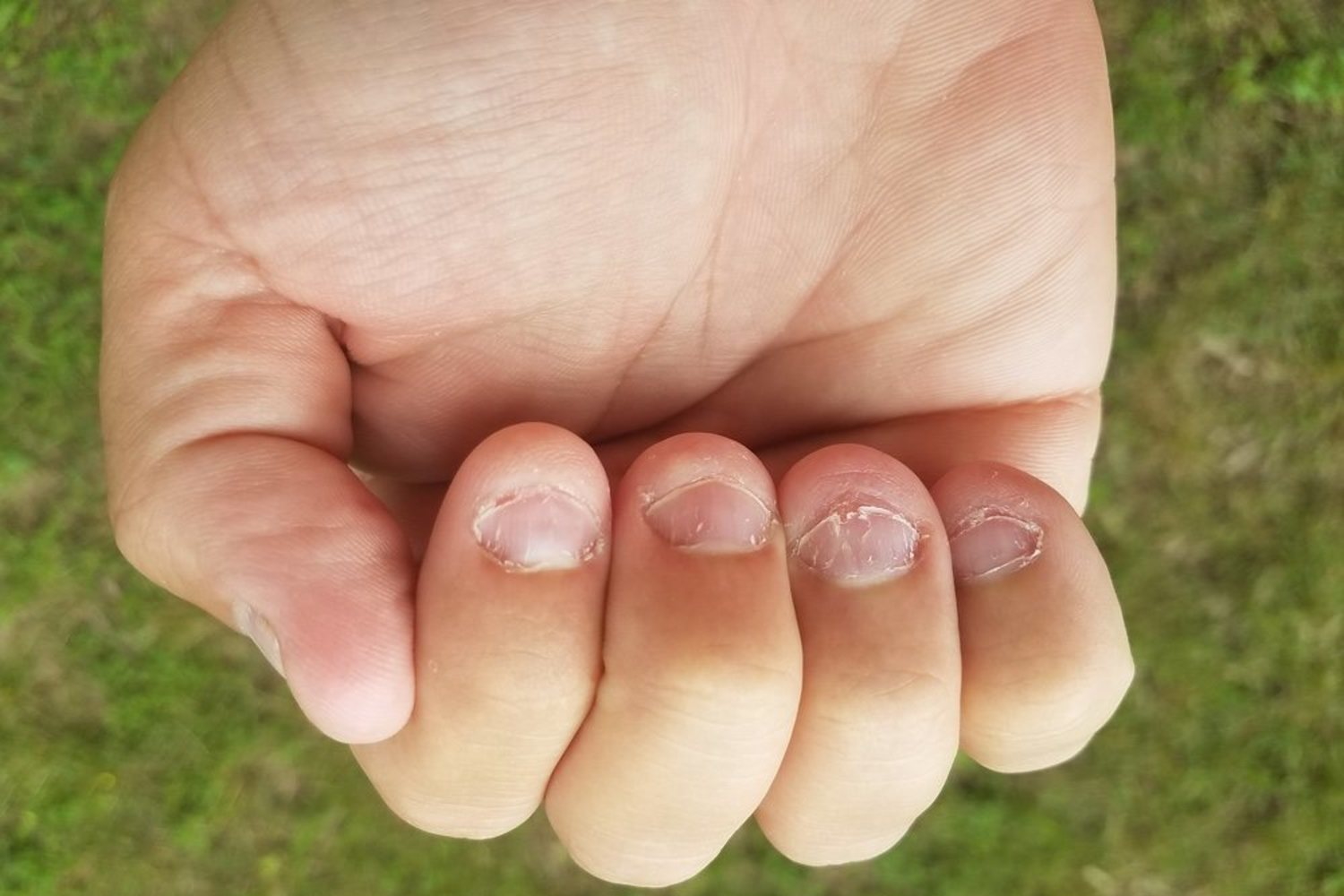 Микронихия: как лечить укороченные ногти