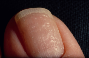 Симптомы наперстковидной истыканности ногтей