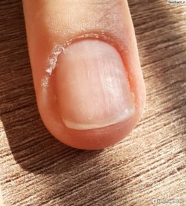 Причины огрубения кожи вокруг ногтя