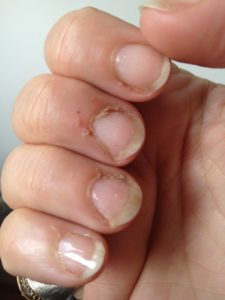 Методы лечения кожи вокруг ногтя