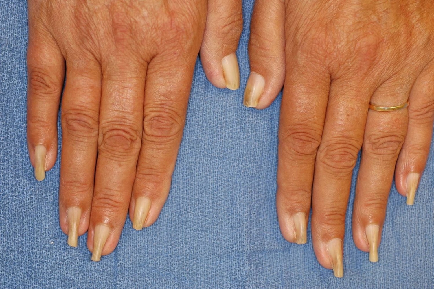 Почему скручиваются ногти: причины, способы лечения и профилактика