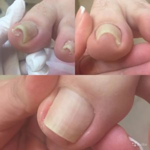 Методы лечения скрученных ногтей