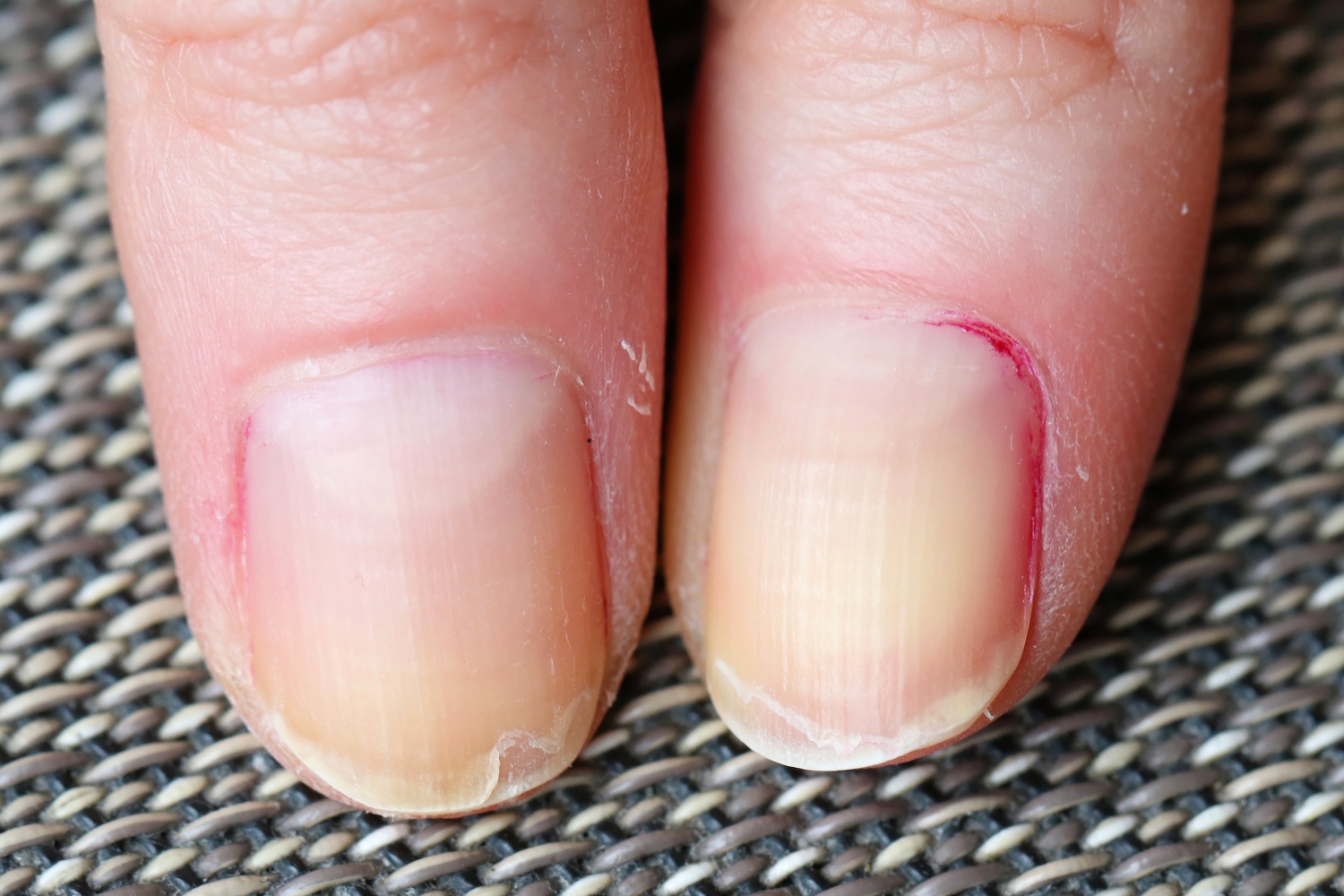 Онихорексис (расщепления ногтей)