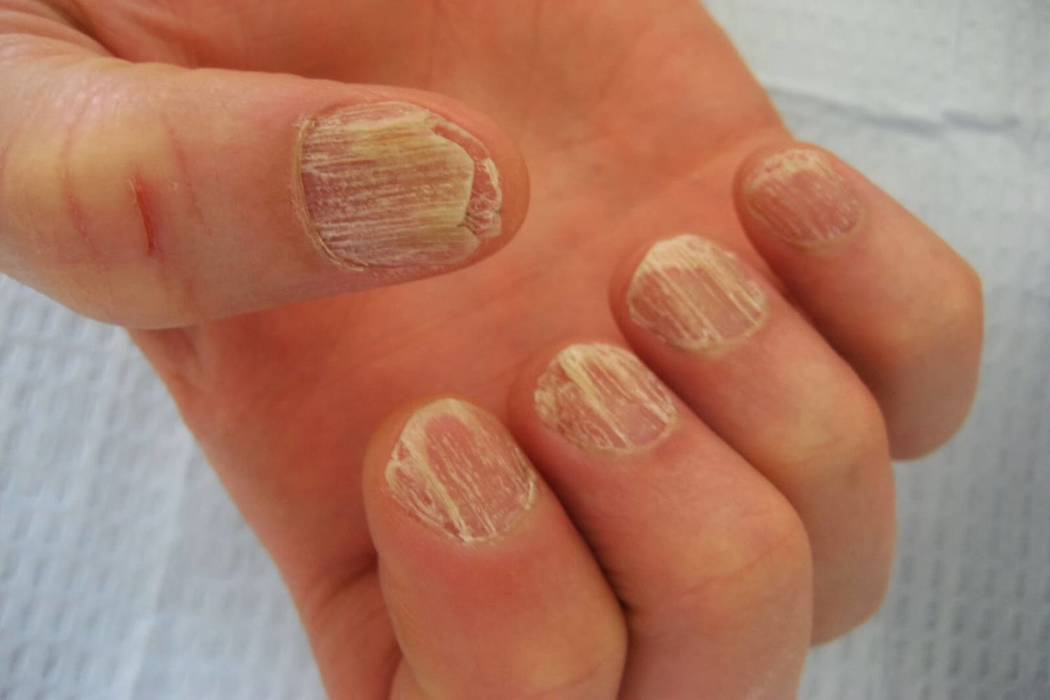 Трахионихия – почему ногти становятся «песчаными»
