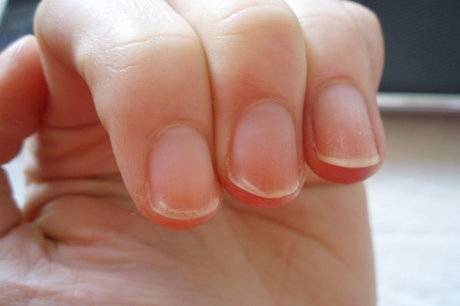 Узуры ногтей: профилактика и лечение