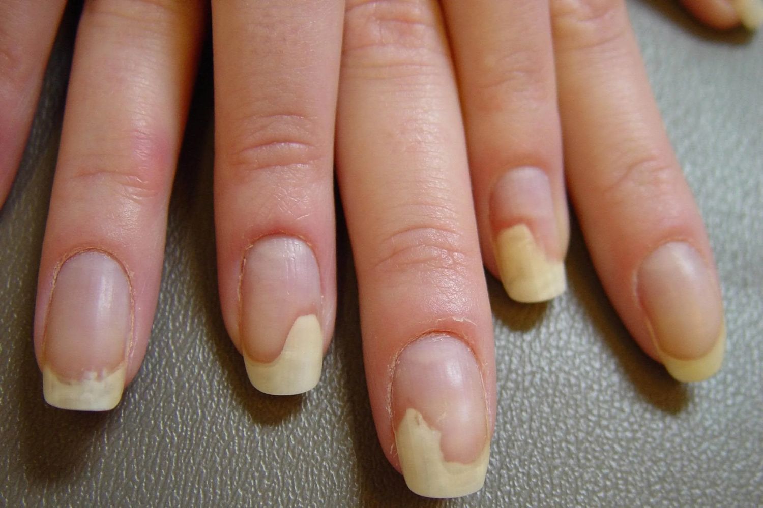 Онихолизис ногтей – причины, симптомы, лечение и профилактика