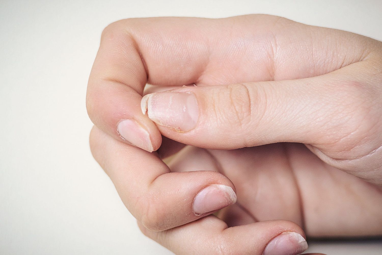 Ломкость ногтей на руках – причины и лечение проблемы